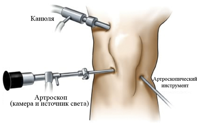 Посттравматичний артроз колінного суглоба: ступеня, симптоми, лікування