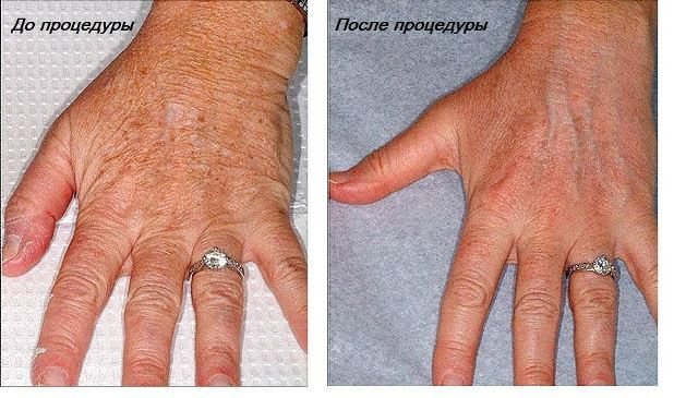 В'ялість шкіри рук - дефект, який зникає при виборі правильної методики.