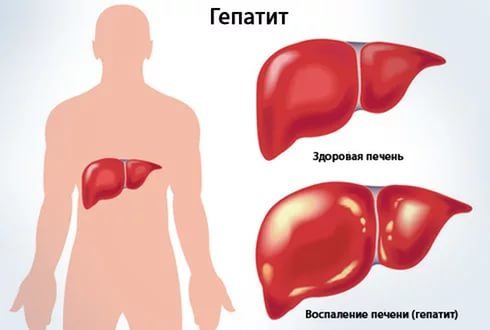 Хронічний гепатит b, c: симптоми, лікування, УЗД-діагностика, прогноз