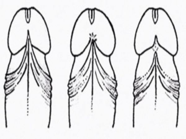 Підрізати вуздечку крайньої плоті статевого члена у чоловіків - коротка вуздечка