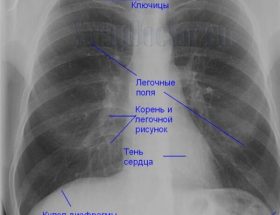Видно чи на рентгені запалення легенів: як розшифрувати знімок дитини