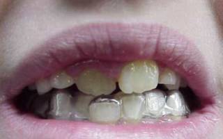 Капа для вирівнювання зубів стоматологічна, як вирівняти зуби елайнери