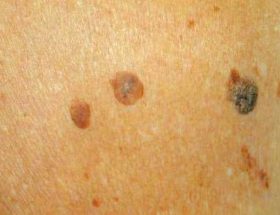 Кератома шкіри: причини появи, супутні симптоми, лікування в клініці і в домашніх умовах