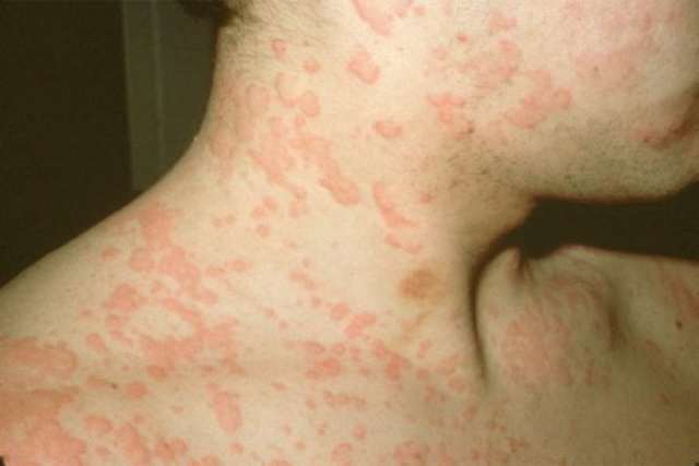 Ознаки алергії у дорослих: фото, симптоми і причини