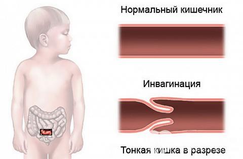 Чорний кал у дитини в 1, 1,5, 2 роки: причини, кров в калі у дитини