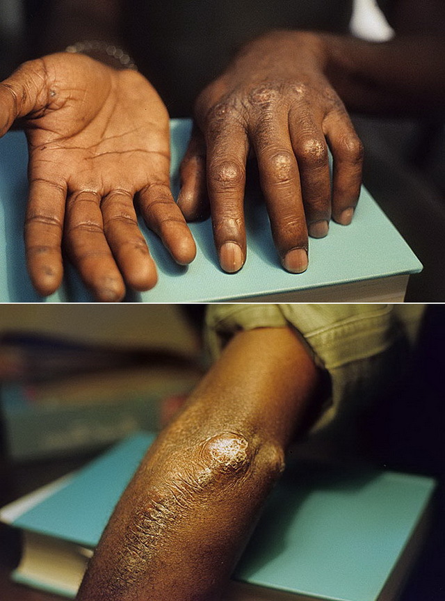 Кальциноз шкіри у людей: причини, симптоми, фото, лікування
