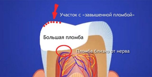 Пломбування зубних каналів: як проводиться, болю після пломбування