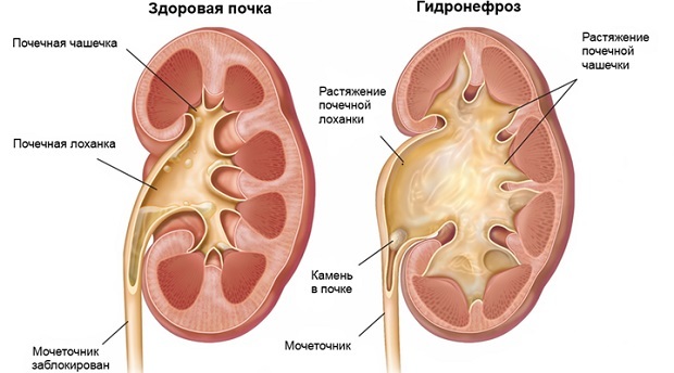 Що робити, якщо болять нирки: симптоми і лікування різних захворювань, народне лікування нирок