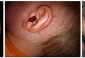 Кровотеча з вуха: провокуючі фактори, тактика лікування та заходи профілактики