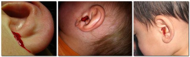 Кровотеча з вуха: провокуючі фактори, тактика лікування та заходи профілактики