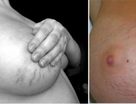 Розтяжки на грудях: причини появи, супутні прояви, методи позбавлення та заходи профілактики