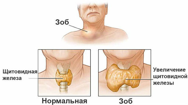 Кашель при щитовидці: симптоми і лікування, методи діагностики і профілактика