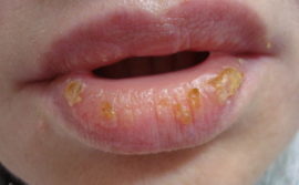 Як лікувати хейліт на губах: ефективні препарати, народні методи, профілактичні заходи
