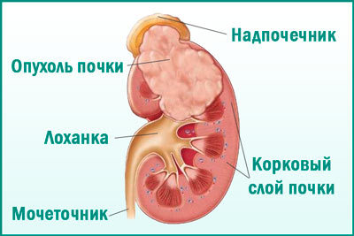 4 стадия почки сколько живут