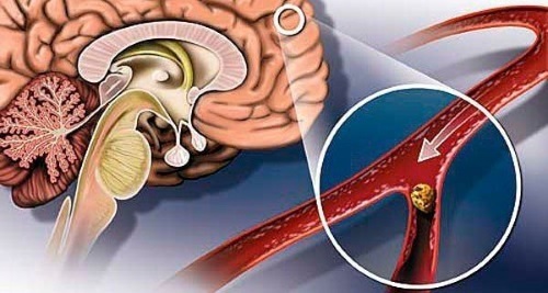 Хронічна недостатність мозкового кровообігу: симптоми і лікування