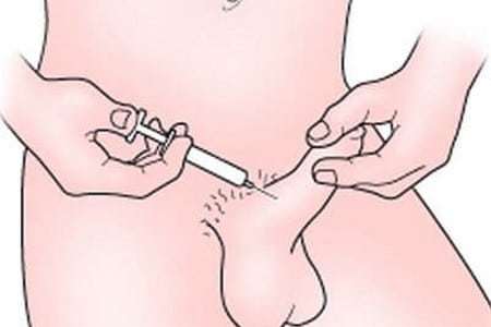 Лікування імпотенції інтракавернозному ін'єкціями: уколи при еректильної дисфункції