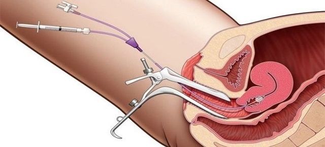 Гистеросальпингография маткових труб: що це, як проводиться, підготовка