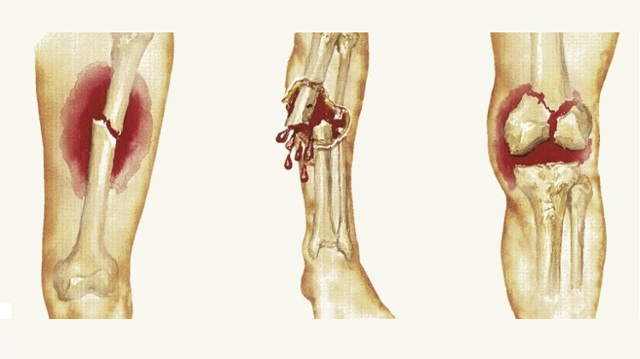 Перша допомога при переломах кісток: що робити при переломі відкритому чи закритому.
