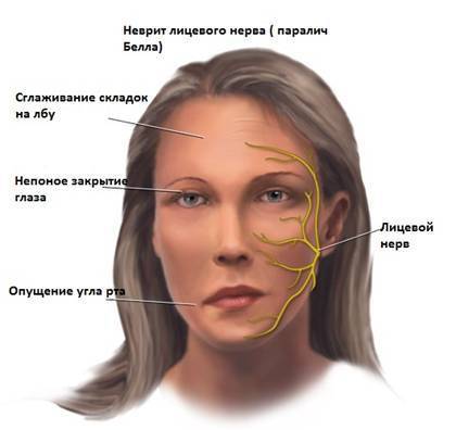 Невралгія: симптоми і лікування невралгії трійчастого нерва, міжреберної невралгії, герпетичної і т.д.