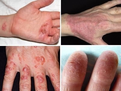 Актініческій дерматит на руках, на обличчі: що це таке, лікування