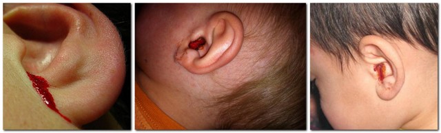 Кровотеча з вуха: причини у дорослих, що робити, якщо з вуха йде кров