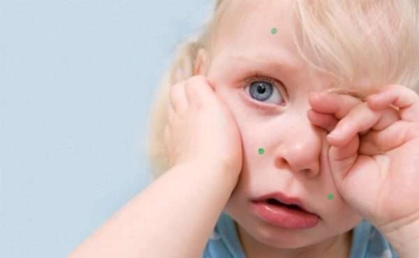 Вітрянка на оці у дитини: чим лікувати, лікування і симптоми