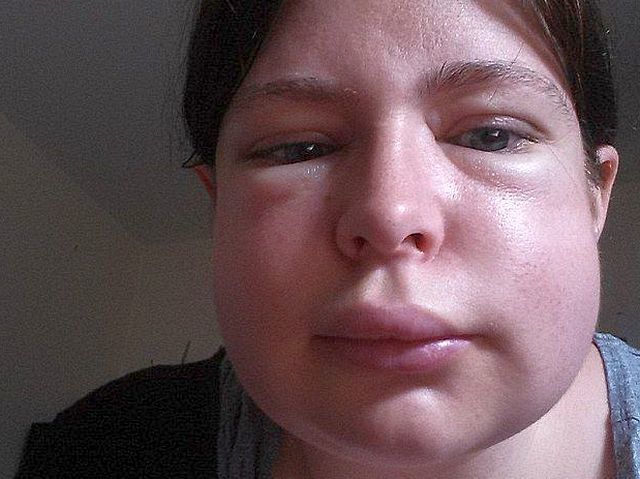 Чим лікувати алергію на обличчі якщо з'явилися червоні плями?