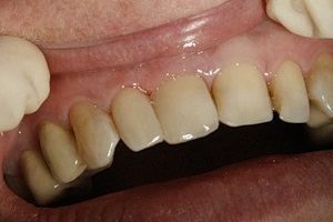 Профессиональное отбеливание зубов системой beyond polus: плюсы и минусы