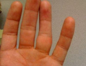 Вивих пальця на руці: типи пошкоджень, характерні симптоми, методи лікування, період реабілітації