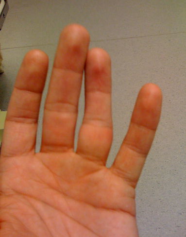 Вивих пальця на руці: типи пошкоджень, характерні симптоми, методи лікування, період реабілітації