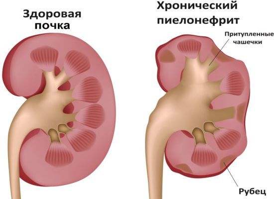 Розшифровка аналізу крові та аналізу сечі по Нечипоренко: що означають результати аналізів сечі і крові