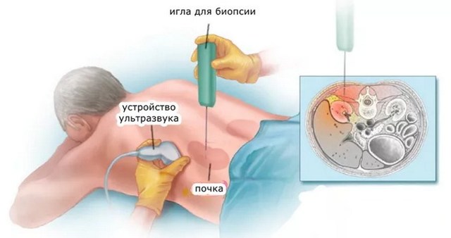 Як робиться біопсія нирок, ускладнення після біопсії, розшифровка біопсії