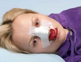 Носова кровотеча у дітей і дорослих: причини частих носових кровотеч, перша допомога при носовій кровотечі і методи зупинки кровотечі з носа