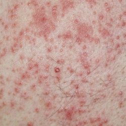Алергічний дерматит: симптоми і лікування алергічного дерматиту у дітей і дорослих