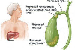 Урсосан і алкоголь - сумісність, через скільки можна пити, наслідки