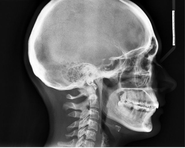 Рентген голови: що показує, як роблять, рентген при струсі у дитини і дорослого