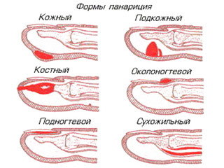 Панариций на пальці руки, ноги, форми панарицію, симптоми і лікування панарицію 