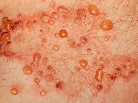 Бульозний дерматит: що це, симптоми і лікування в домашніх умовах