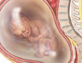 Багатоводдя при вагітності: причини і форми патології, тактика лікування і наслідки на пізньому терміні