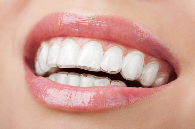 Капа для вирівнювання зубів стоматологічна, як вирівняти зуби елайнери