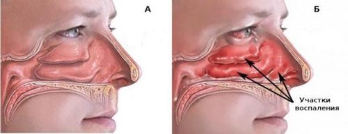 Гормональні краплі в ніс від нежиті: назви кращих препаратів