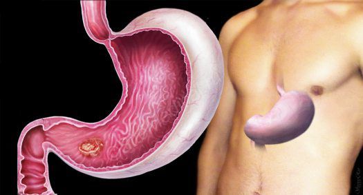 Доброякісні пухлини шлунка: симптоми, лікування, ускладнення, ризики раку