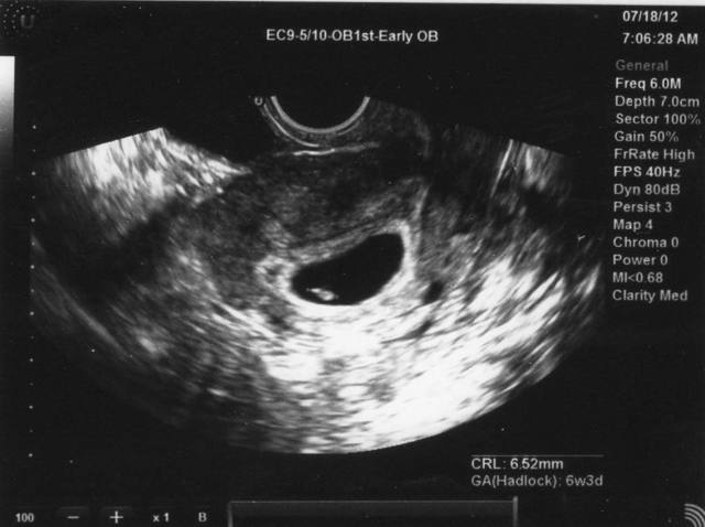 3 тиждень вагітності: ознаки і відчуття матері, необхідність УЗД і медичного обстеження