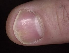 Псоріаз нігтів на руках і ногах: причини, фото патології, ефективні методи лікування