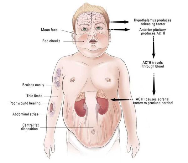 Хвороба Іценко-Кушинга - симптоми, діагностика та лікування синдрому Іценко-Кушинга