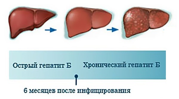 Хронічний гепатит В, С: як проявляється, причини і прогноз докторів