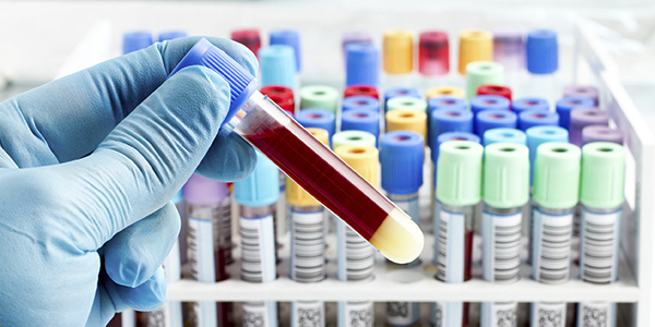 Аналіз крові на біохімію: в якому разі проводиться, розшифровка біохімічного аналізу крові, трактування результатів