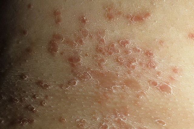 Інтертрігинозний псоріаз складок шкіри: причини розвитку захворювання, діагностика, способи терапії, прогноз лікарів