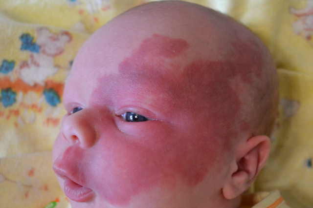 Вроджена аплазія шкіри волосистої частини голови у новонароджених: симптоми, лікування