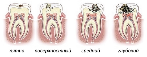 Пломбування зубних каналів: як проводиться, болю після пломбування